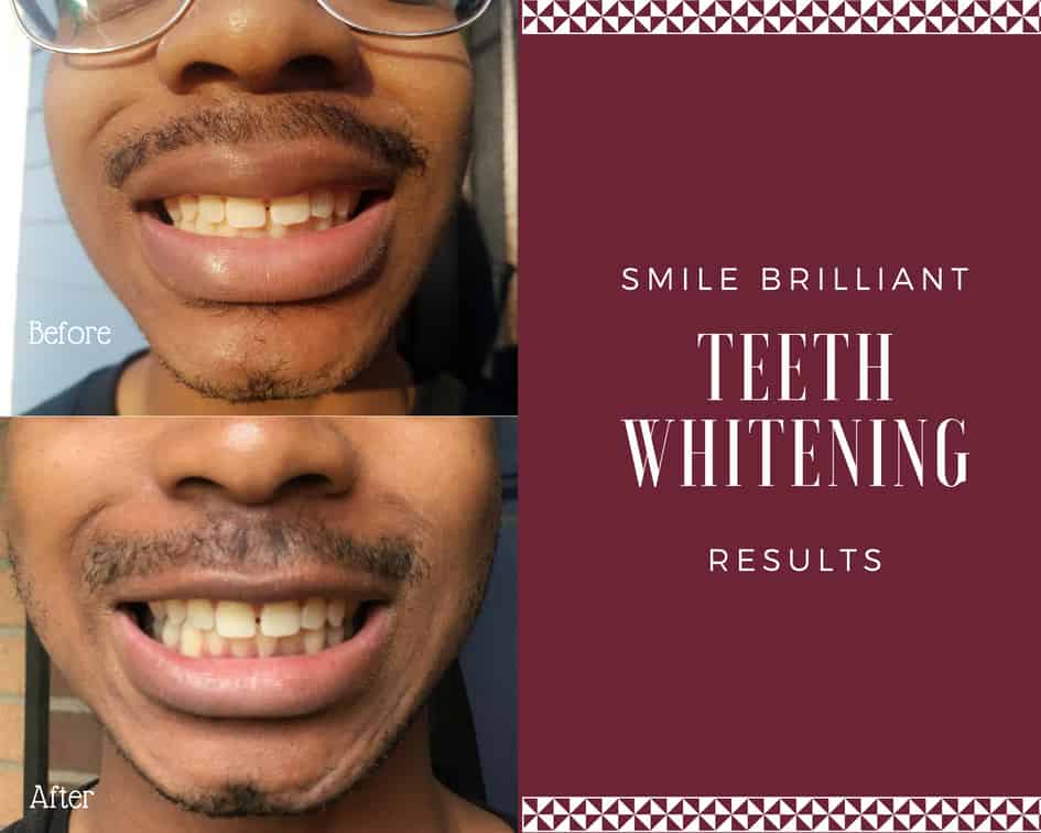 Smile Brilliant At Home Teeth Whitening System