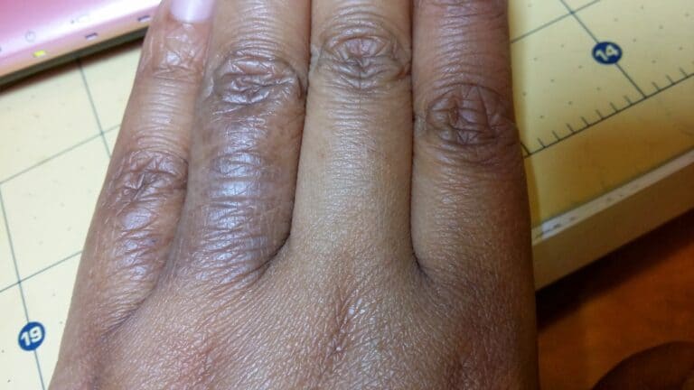 Atopic Dermatitis in Darker Skin Tones