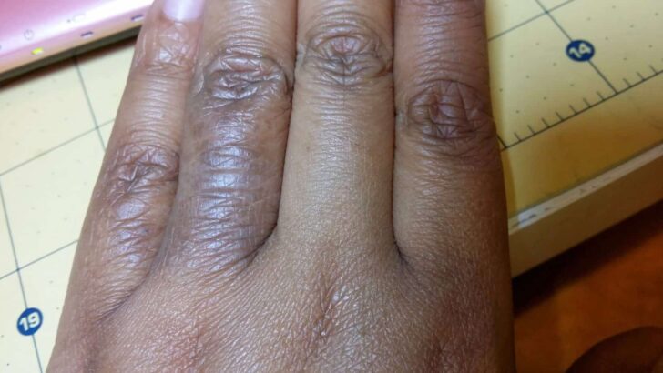 Atopic Dermatitis in Darker Skin Tones