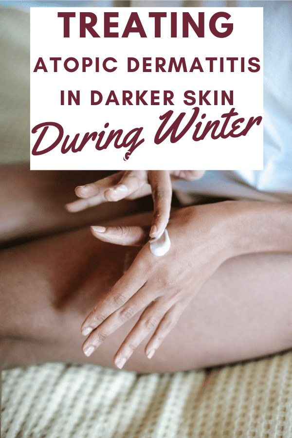 Treating Atopic Dermatitis in Darker Skin