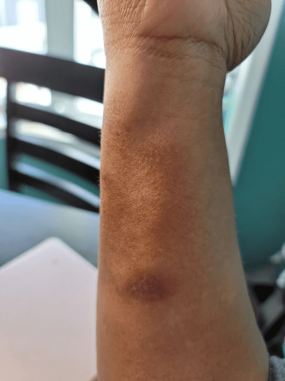 Treating Atopic Dermatitis in Darker Skin