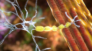 Illustrated breakdown of multiple sclerosis - types, symptoms, and who is at risk