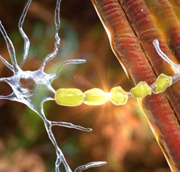 Illustrated breakdown of multiple sclerosis - types, symptoms, and who is at risk